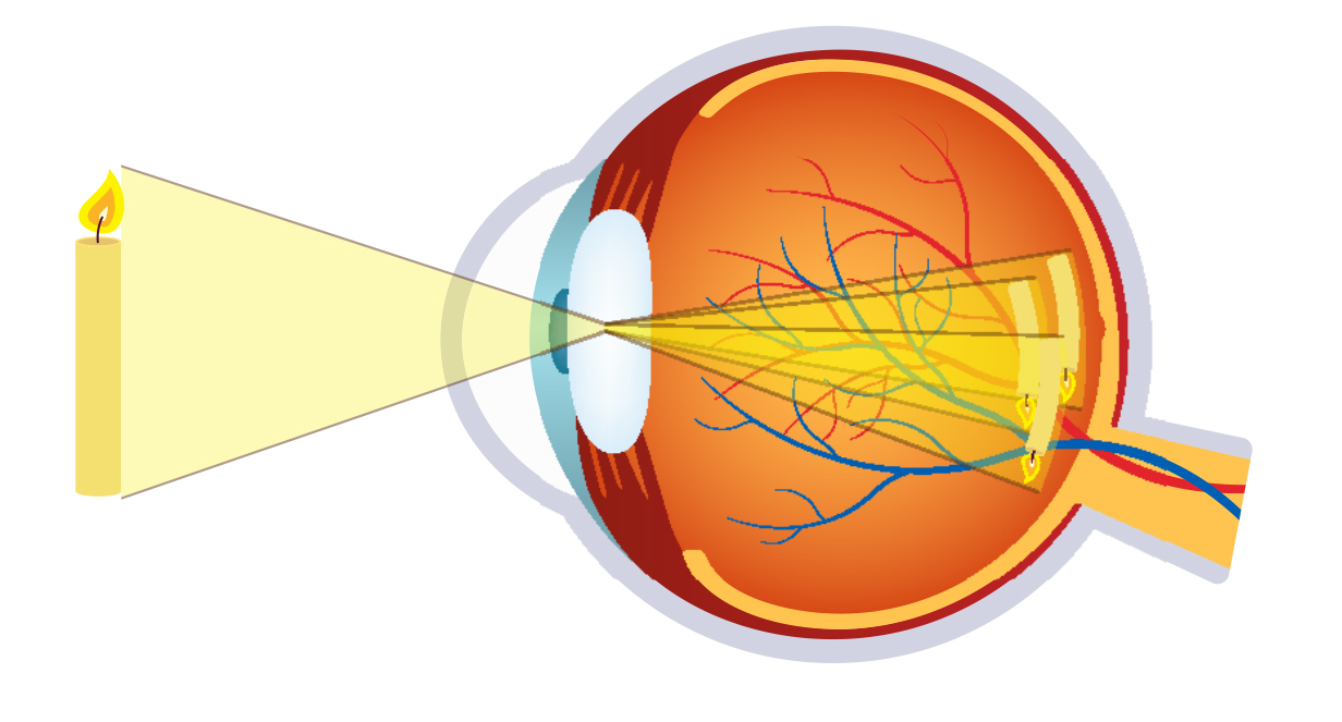 astigmatism