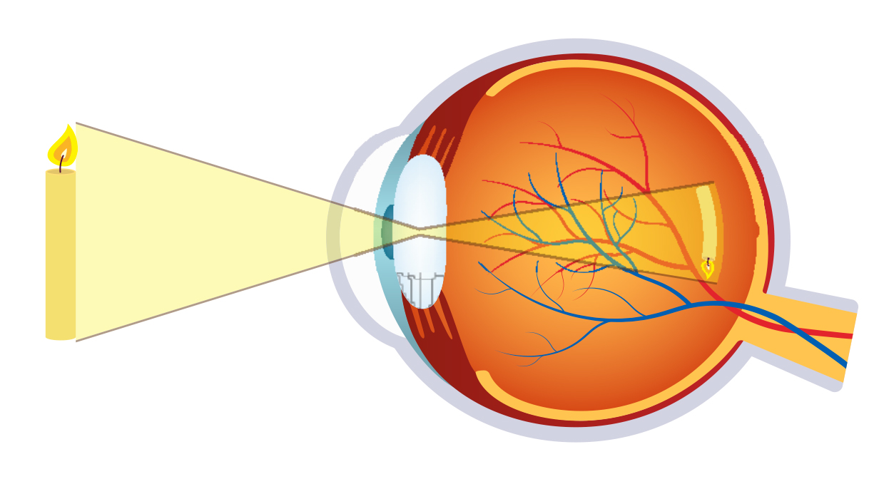 myope